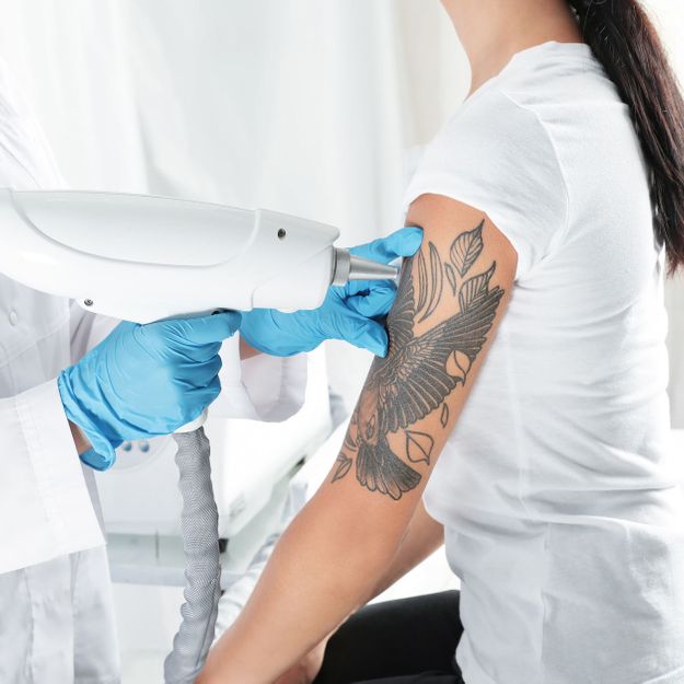 tattoo removal